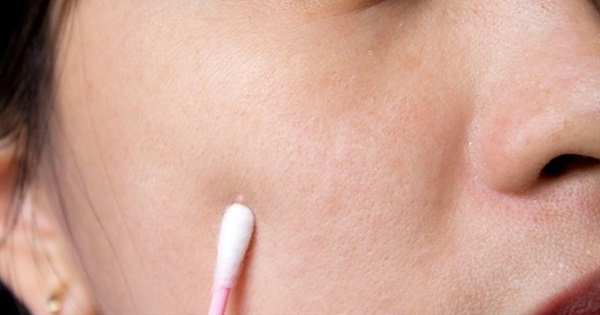 12 Tips For Getting Rid Of Acne Scars